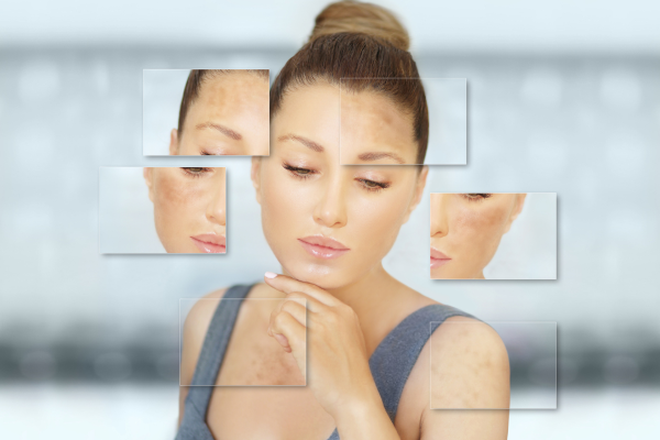 Tinh dầu trị nám tàn nhang 1